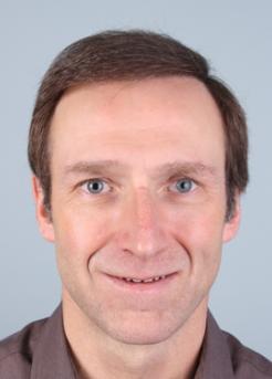 After Hair Transplant&nbsp;Front